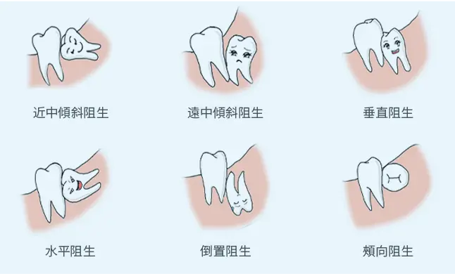 珠海剝阻生牙收費