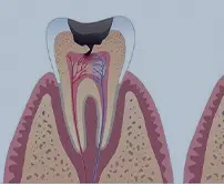 拱北杜牙根牙套介紹