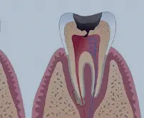 拱北杜牙根牙套介紹