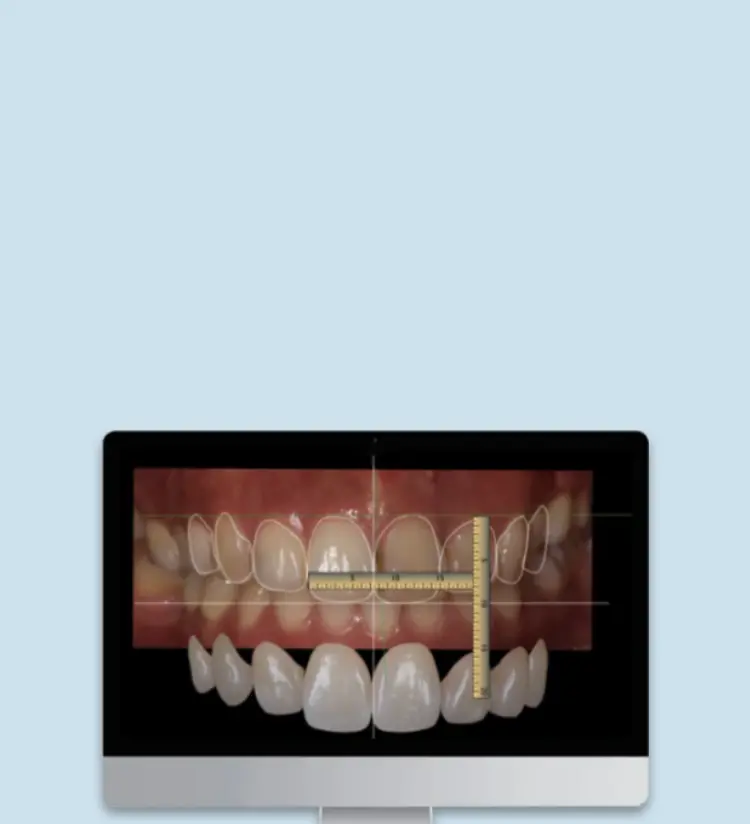 珠海拱北牙貼費用
